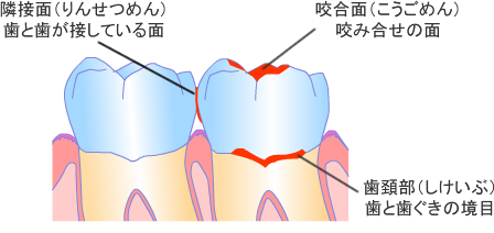 虫歯になりやすい箇所