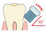 歯ブラシのあて方